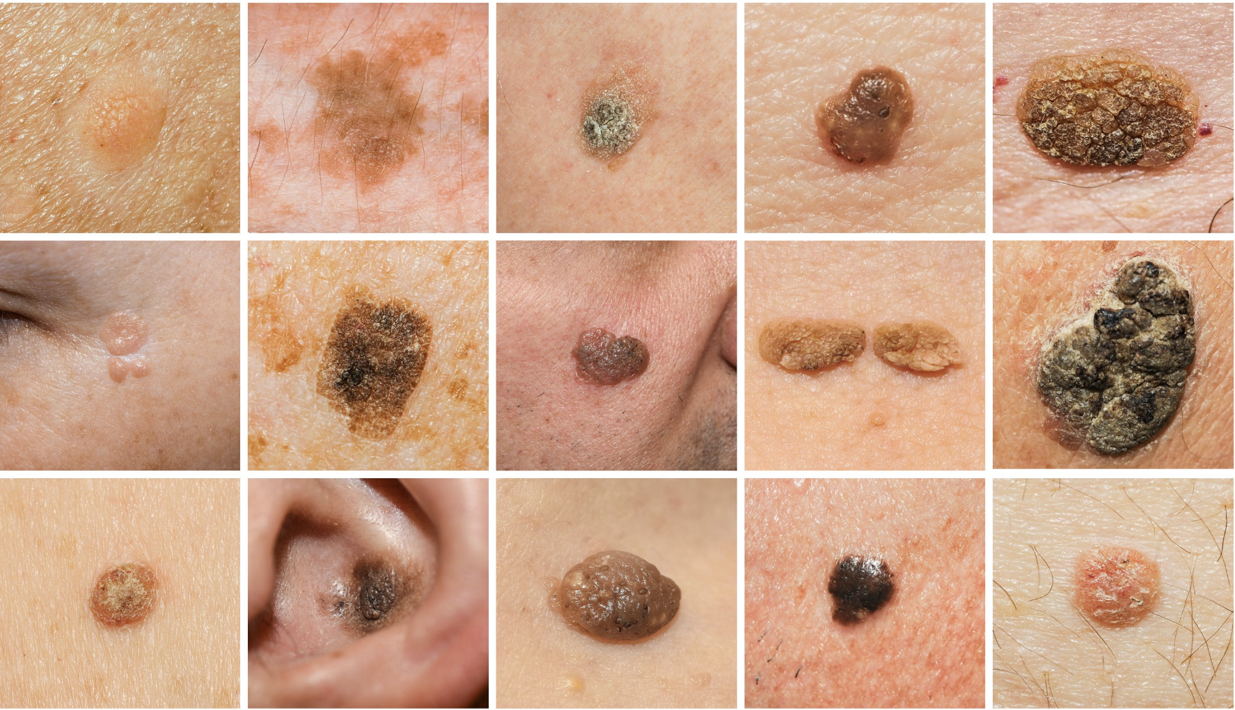 Gutartige Hauttumoren dermatologisch untersuchen und behandeln