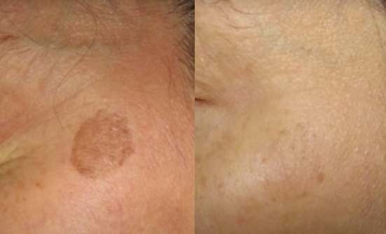Altersflecken und Pigmentflecken mit Laser behandeln