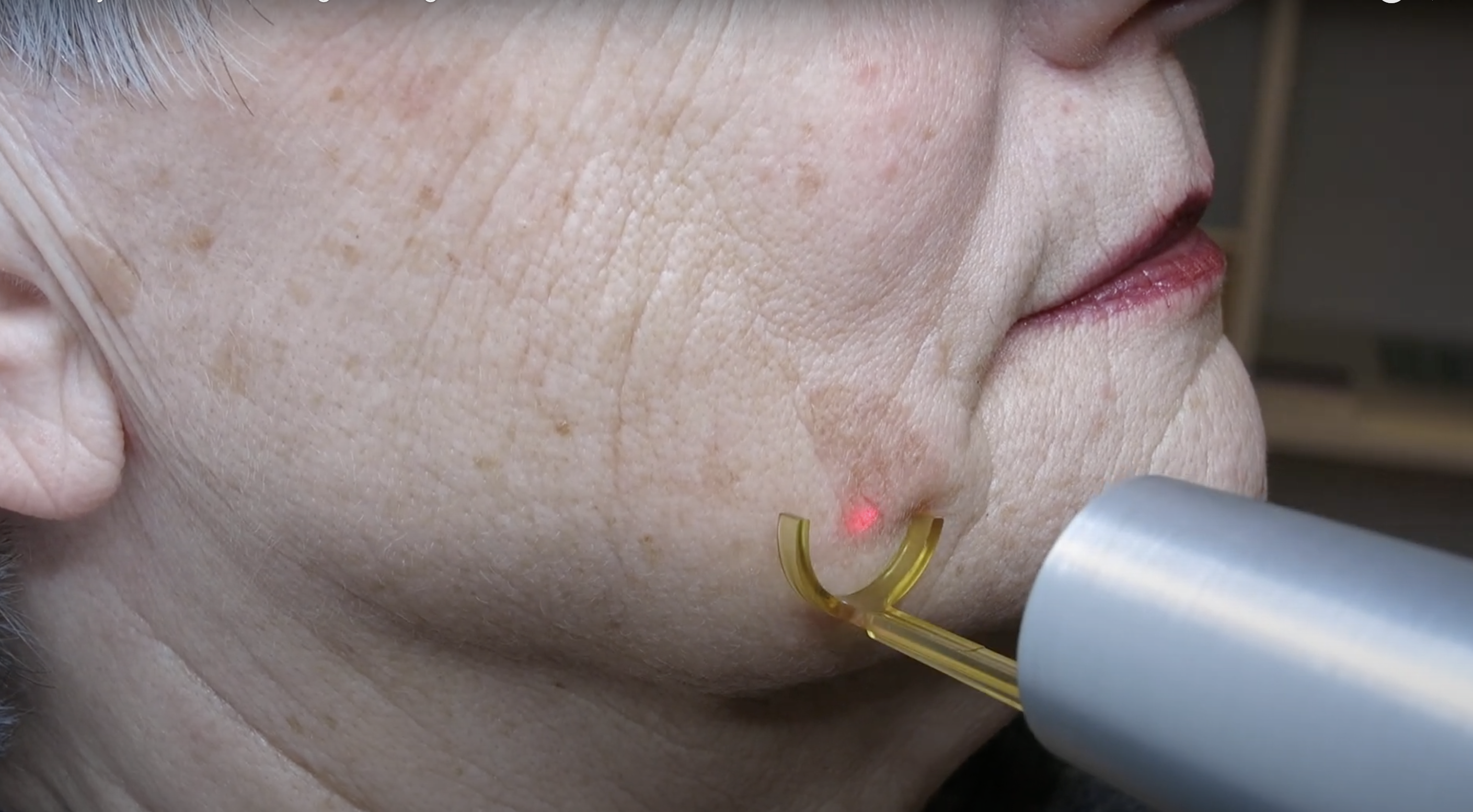 Laser nach Befund zur Entfernung von Altersflecken und Pigmentflecken