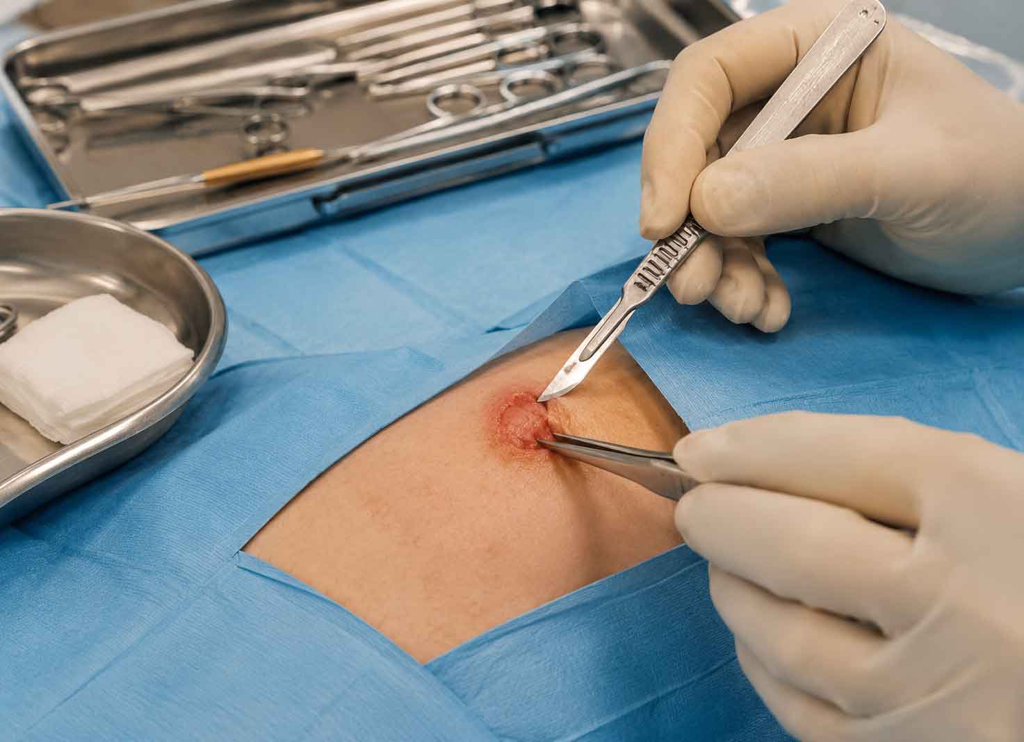 Operative Entfernung größerer oder therapieresistenter Feigwarzen