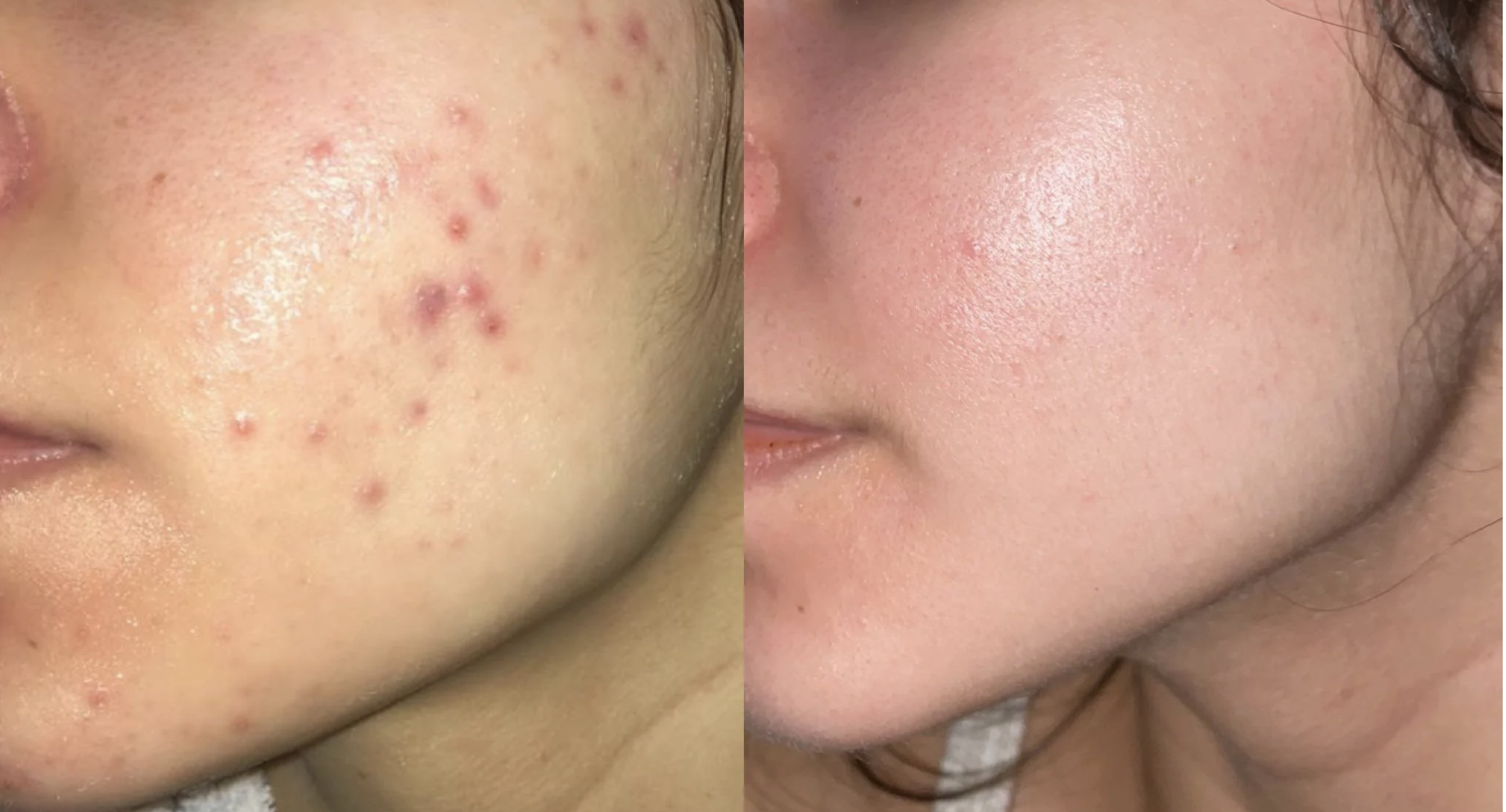 Akne und Aknenarben dermatologisch behandeln