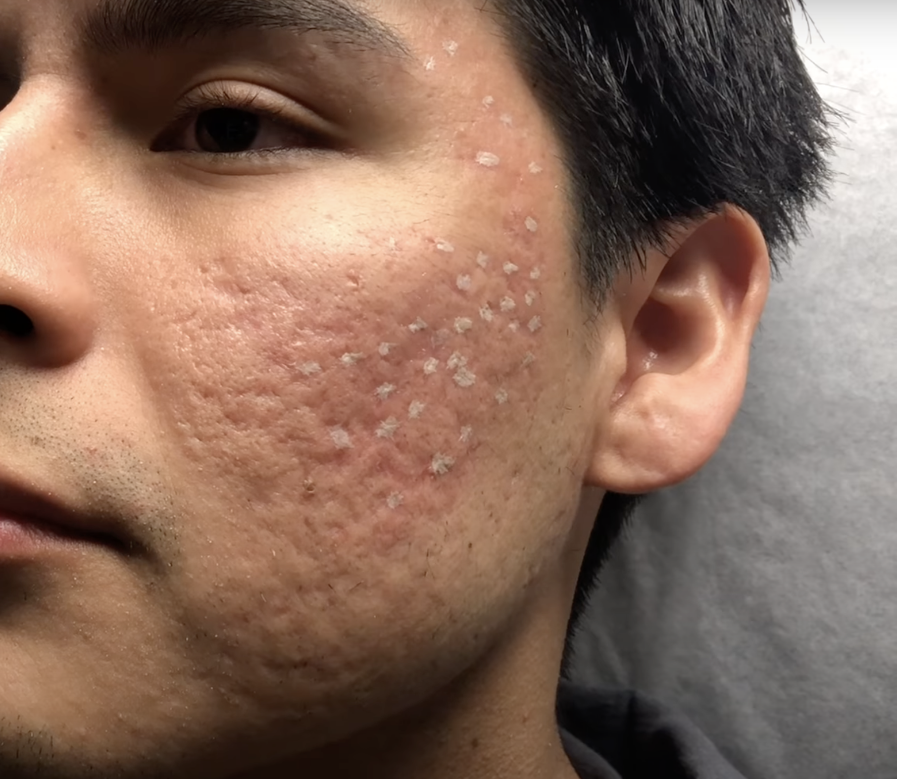 Chemisches Peeling bei Aknenarben und postentzündlichen Flecken