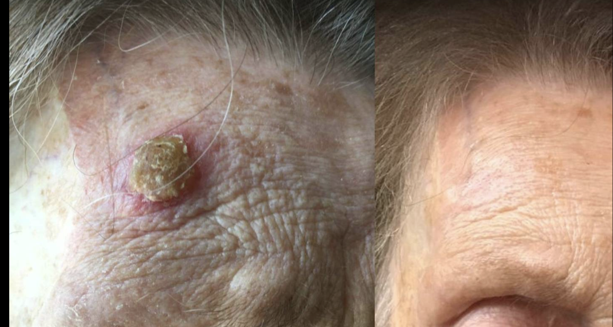 Hautläsionen dermatologisch und chirurgisch entfernen