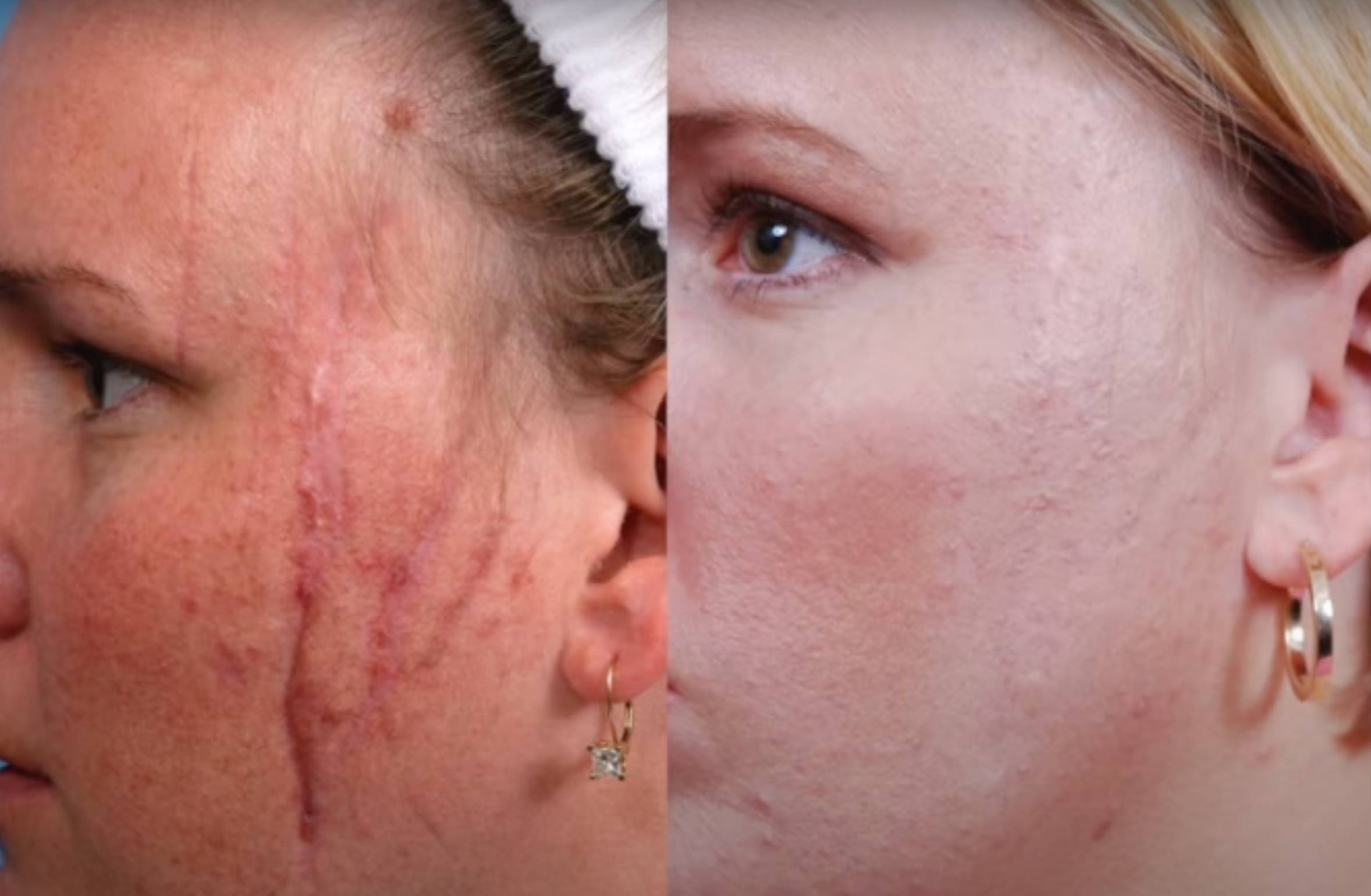 Postoperative und kontrakte Narben Postoperative und kontrakte Narben vor Behandlungsplanung