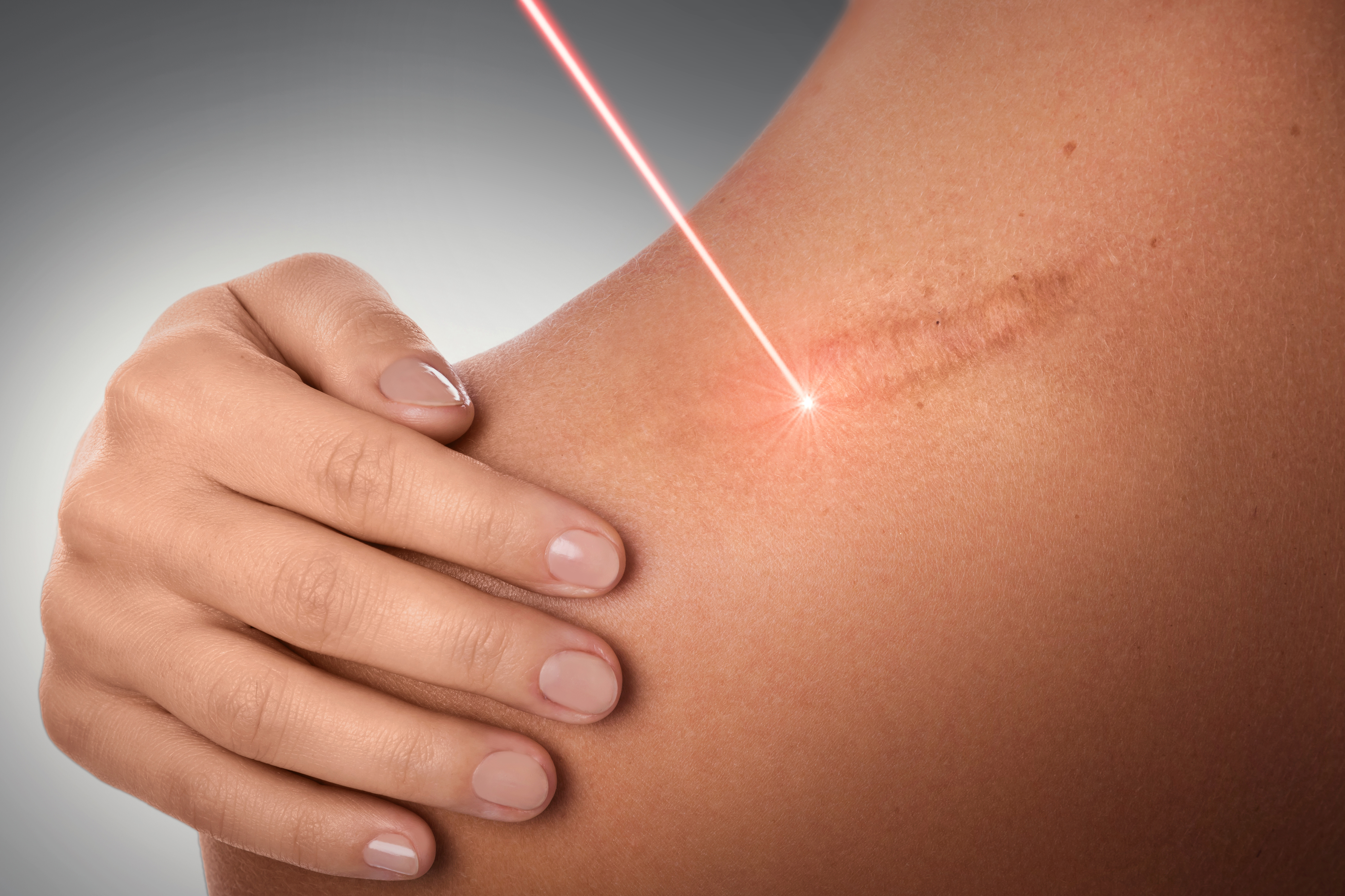 Konservative Narbenkorrektur Konservative Narbenkorrektur mit Laser und dermatologischen Verfahren