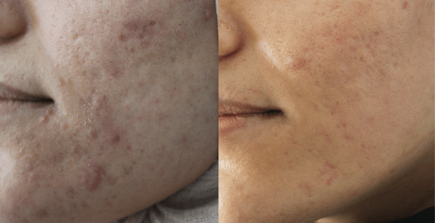 Aknenarben Foto vor und nach Behandlung Aknenarben Foto vor und nach Behandlung