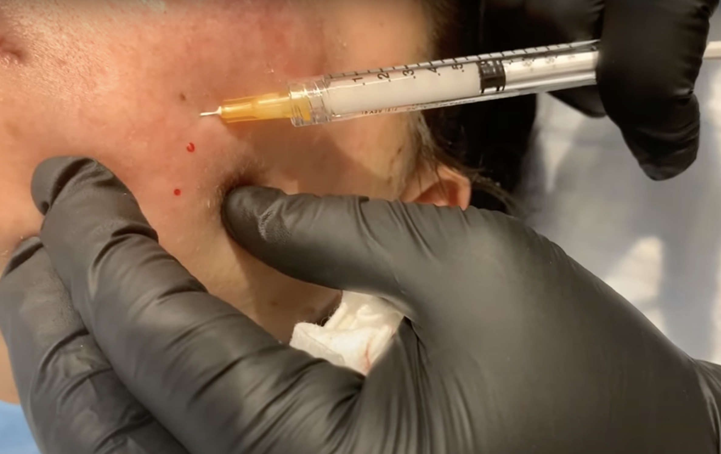 Füllstoffe mit Hyaluronsäure bei eingesunkenen Aknenarben