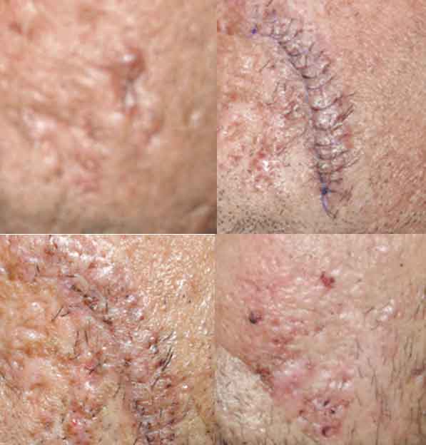 Chirurgische Aknenarbenkorrektur durch Stanzexzision oder Exzision