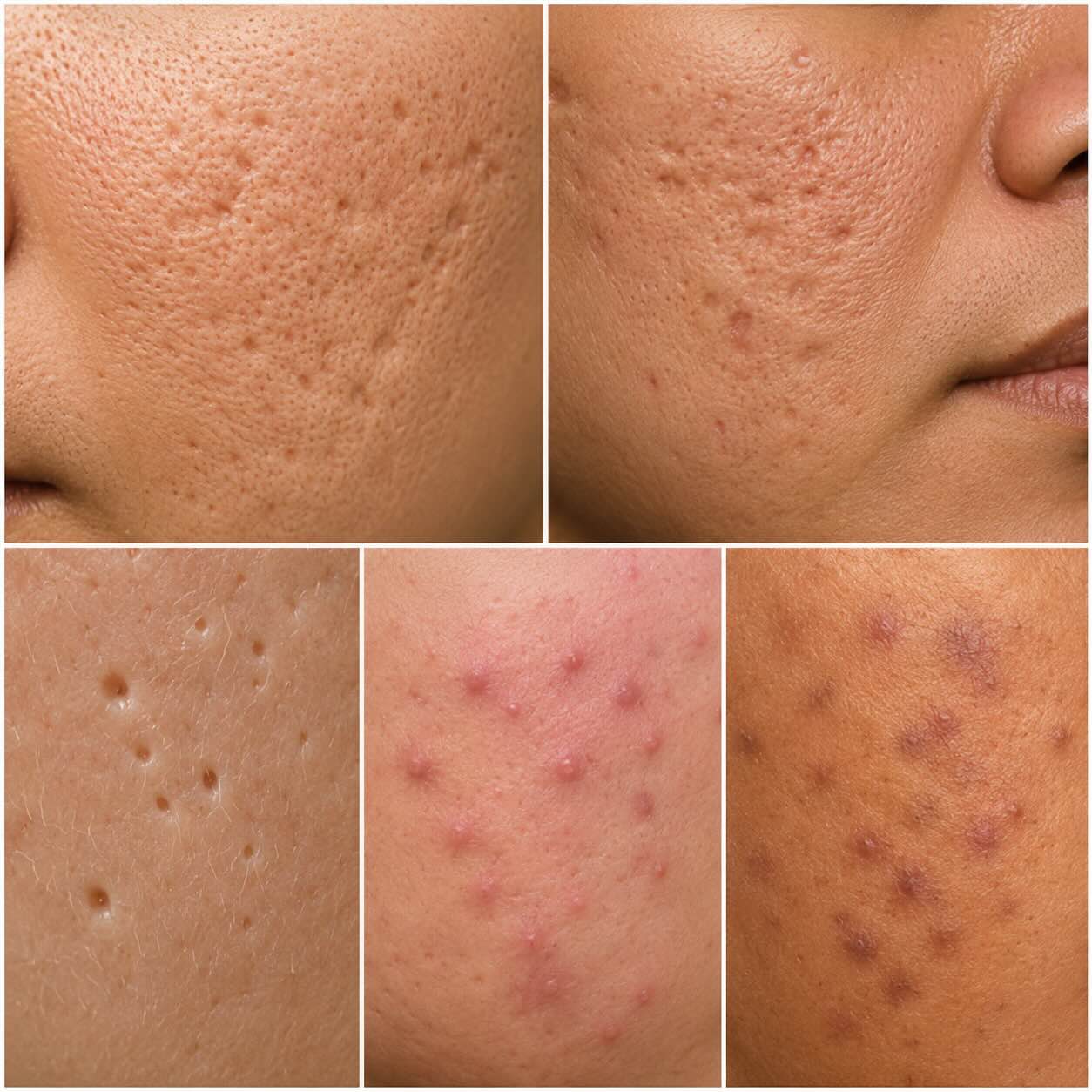Aknenarbenformen dermatologisch richtig einordnen Aknenarbenformen dermatologisch richtig einordnen
