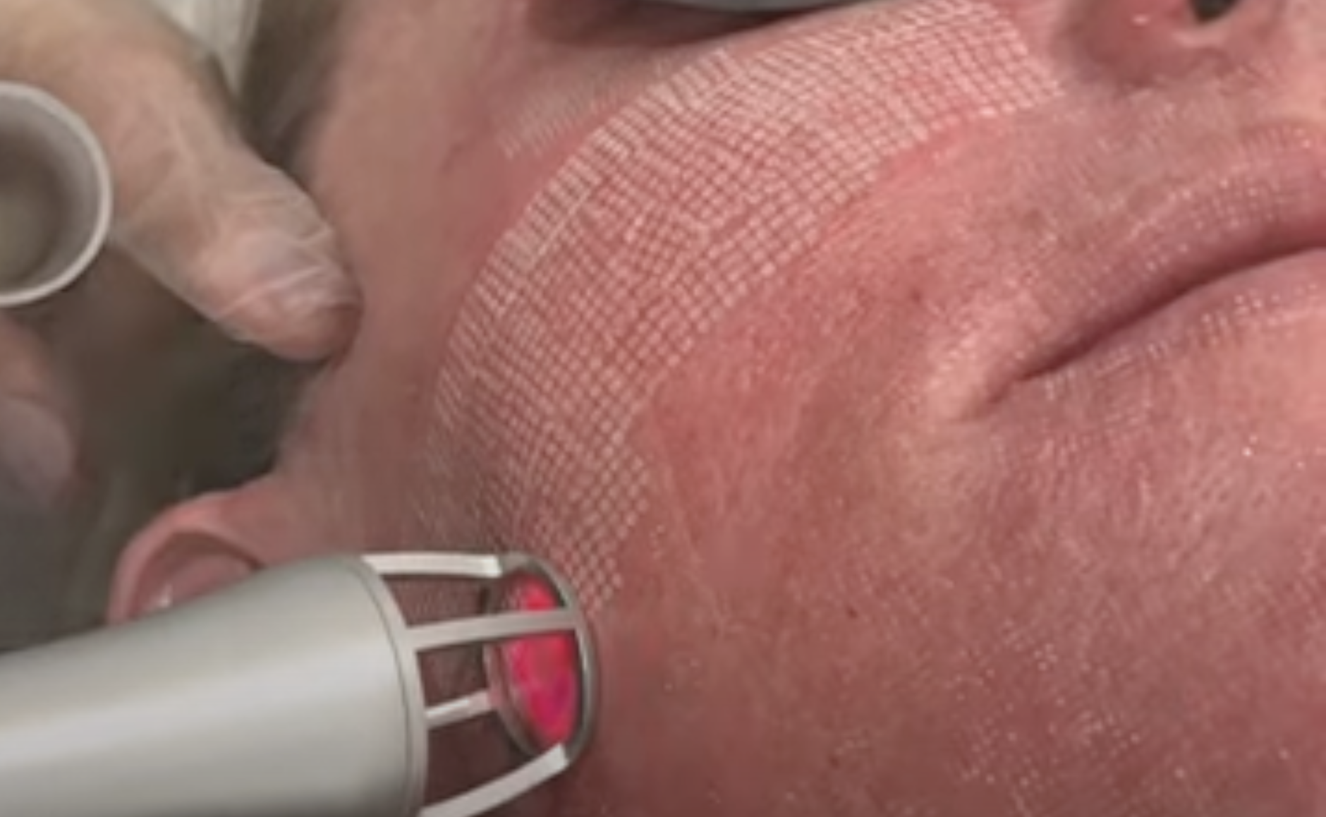 CO2-Laserbehandlung und fraktionales Resurfacing