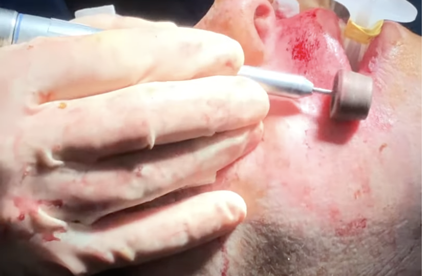 Dermabrasion und Mikrodermabrasion bei oberflächlichen Aknenarben