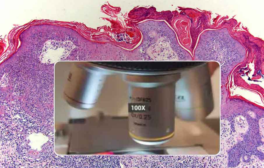 Histologische Untersuchung nach Entfernung einer unklaren Alterswarze in Hanau