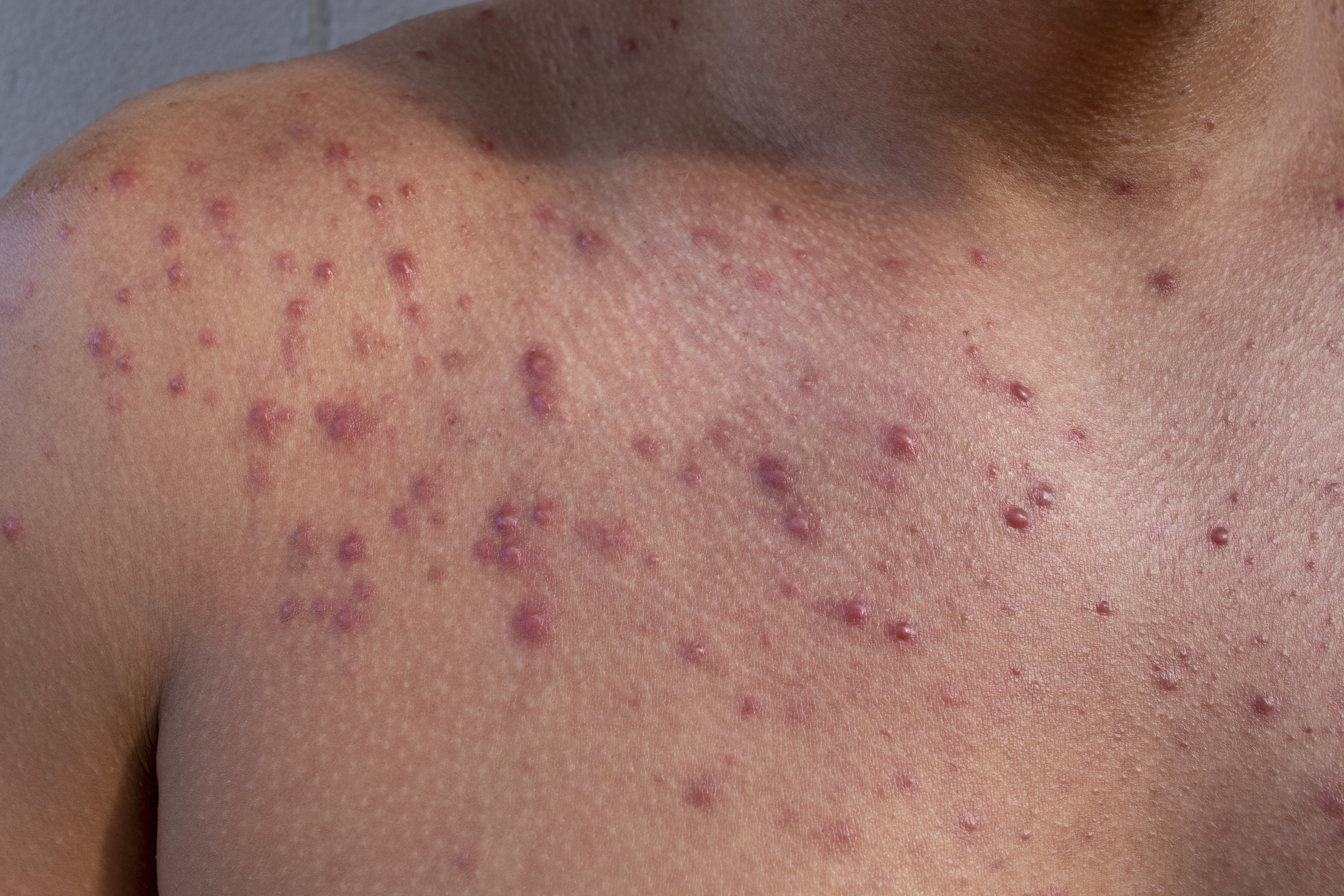 Hypertrophe Aknenarben und Keloidnarben Hypertrophe Aknenarben und Keloidnarben