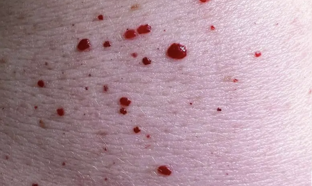 Rubinflecken als kleine rote Gefäßknötchen bei Erwachsenen