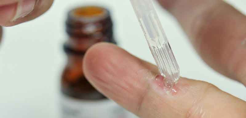 Warzen mit Laser dermatologisch behandeln