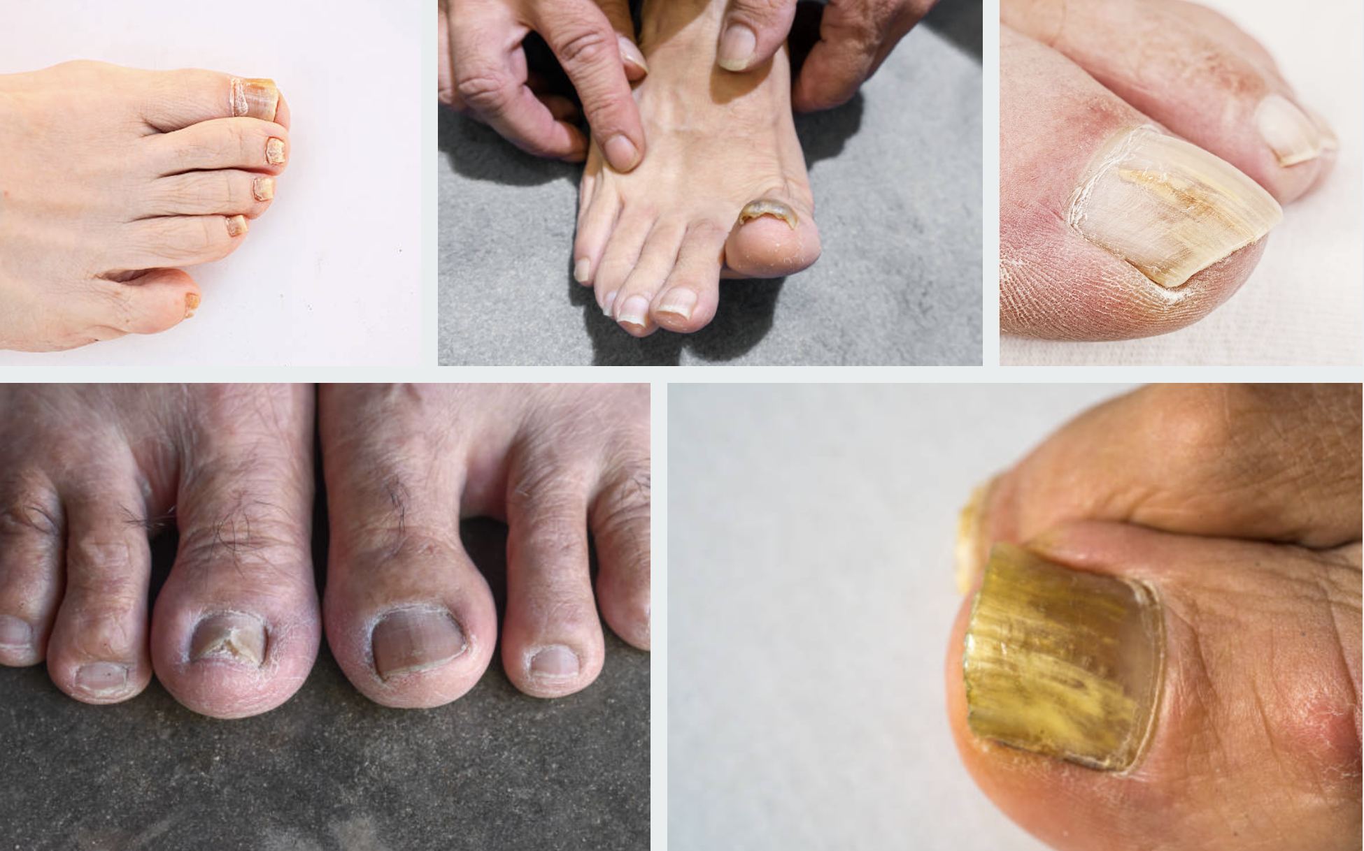 Nagelpilz und Onychomykose als wichtige Differenzialdiagnose in der Nagelsprechstunde Hanau