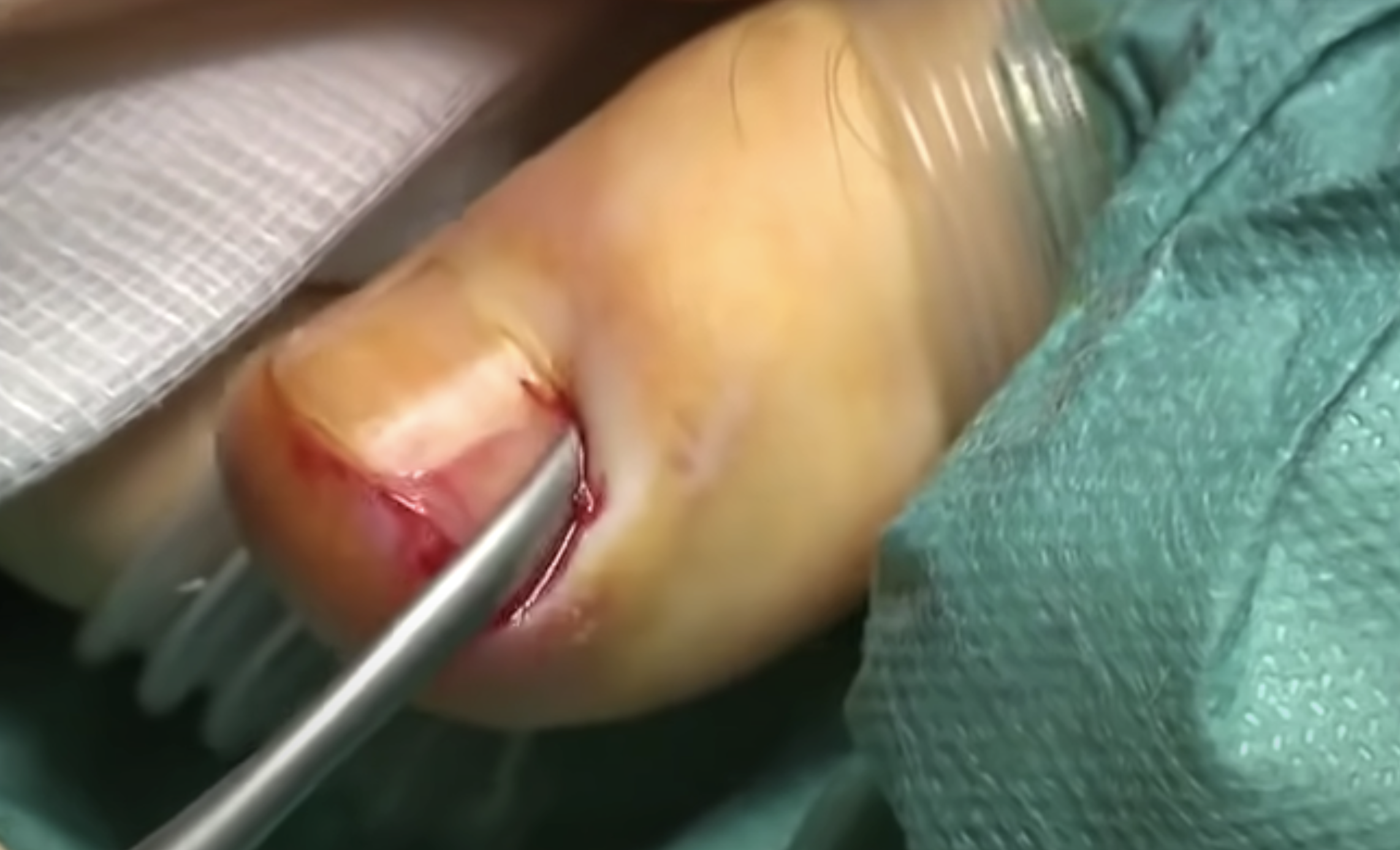 Nagelchirurgie bei unklaren oder schmerzhaften Nagelveränderungen