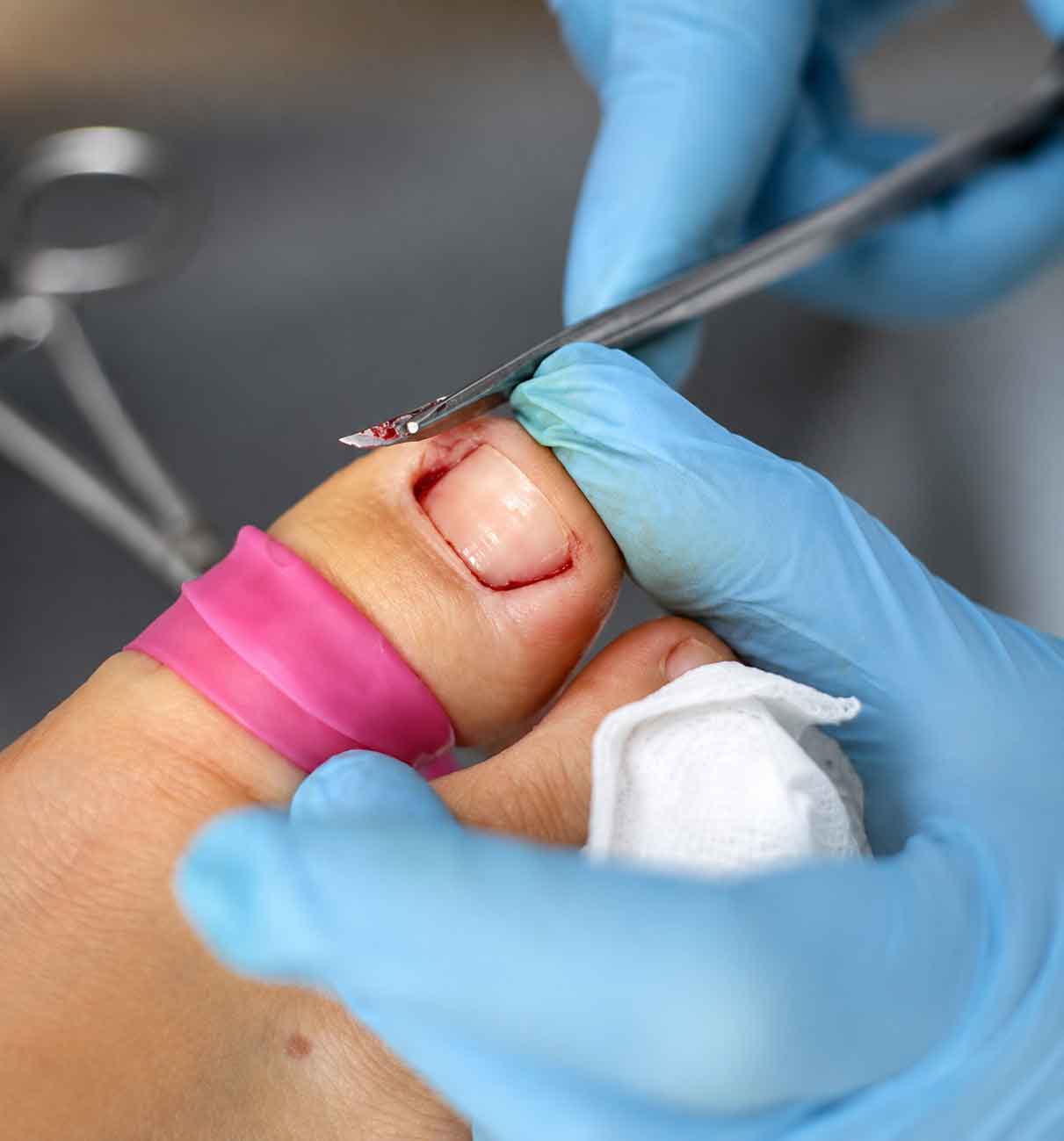 Debridement und mechanische Entlastung bei Nagelerkrankungen