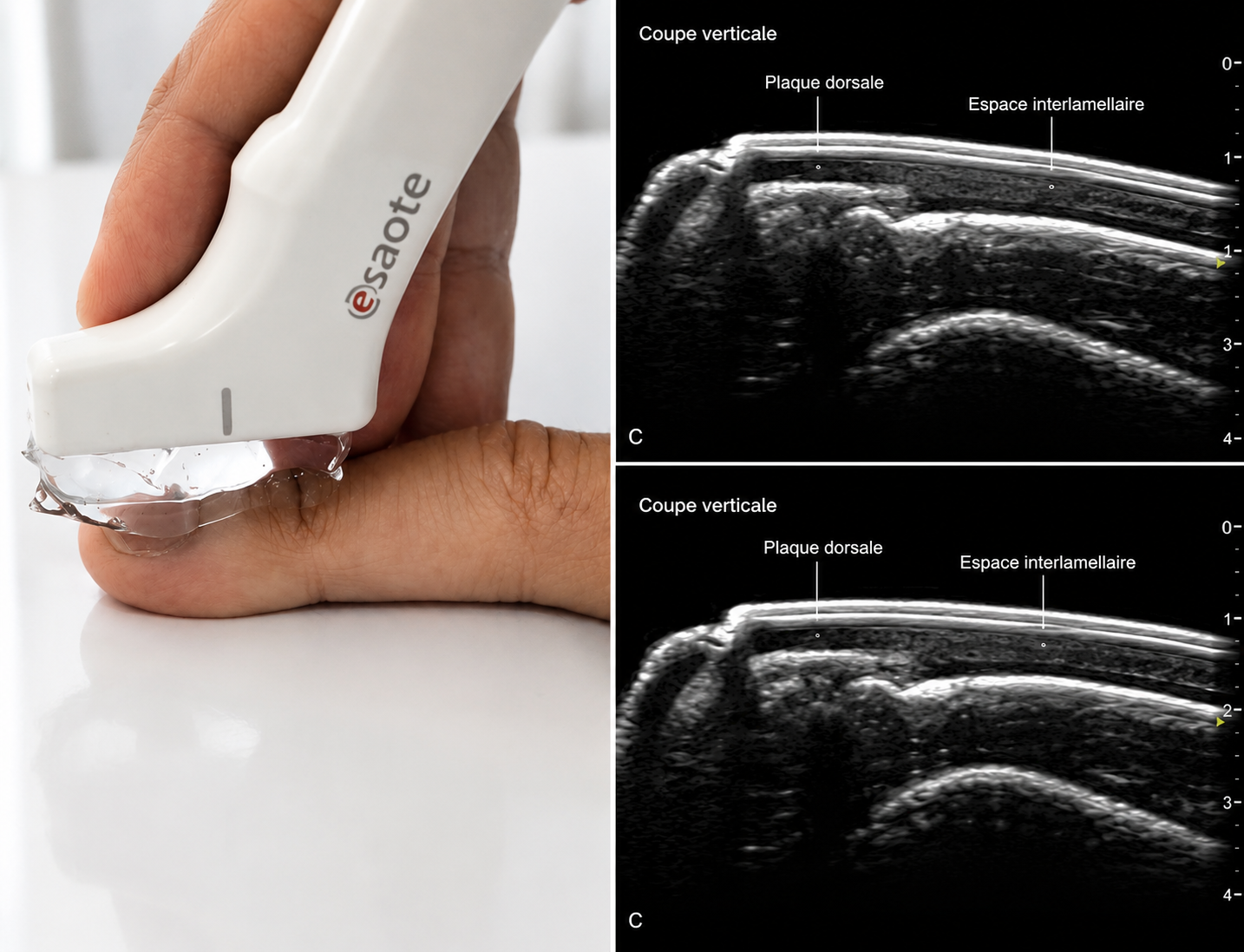 Nagelsonographie und Ultraschall zur ergänzenden Beurteilung tieferer Nagelstrukturen