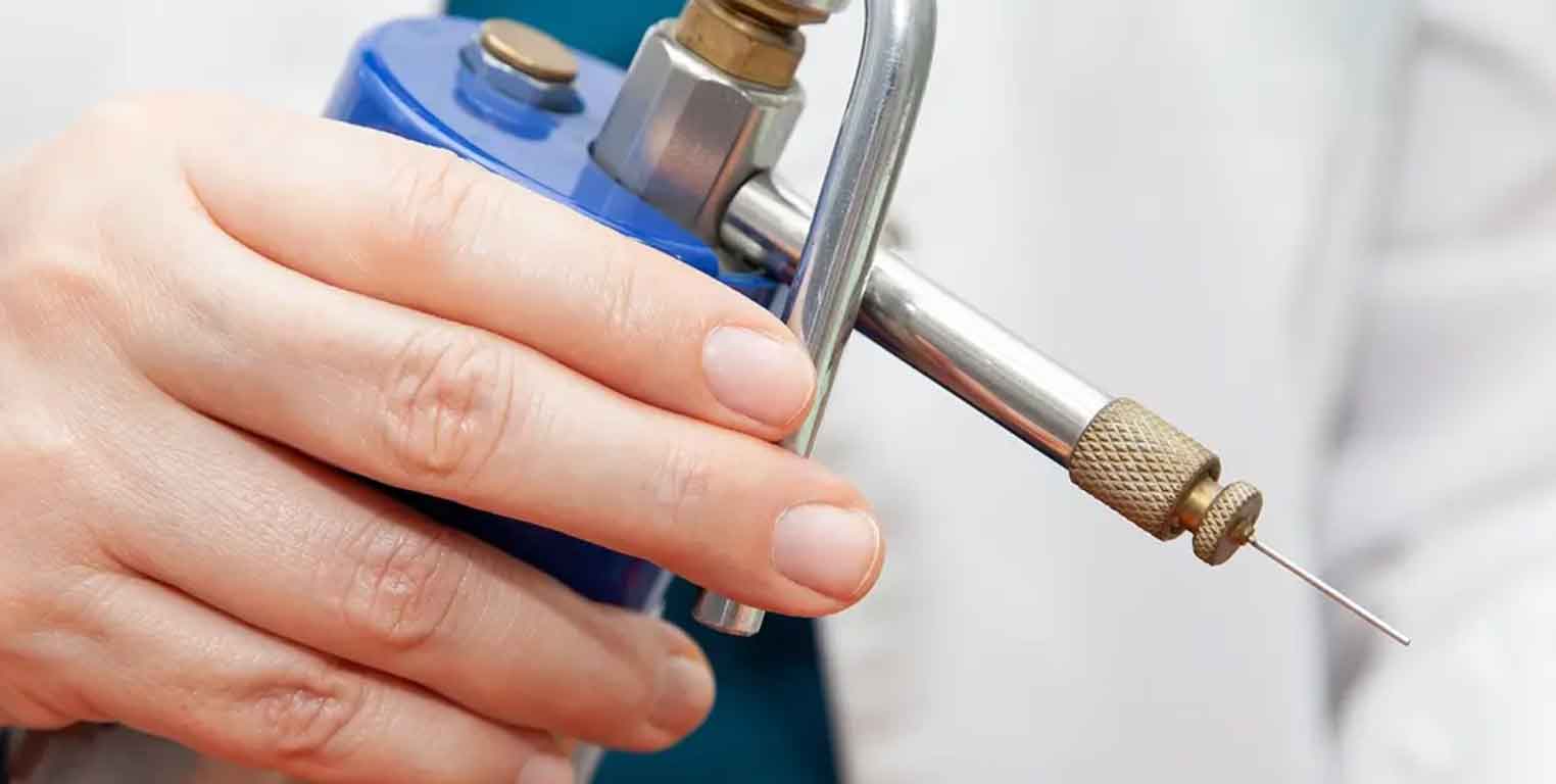 Kryotherapie zur Kältebehandlung gutartiger oberflächlicher Hautveränderungen beim Hautarzt in Hanau