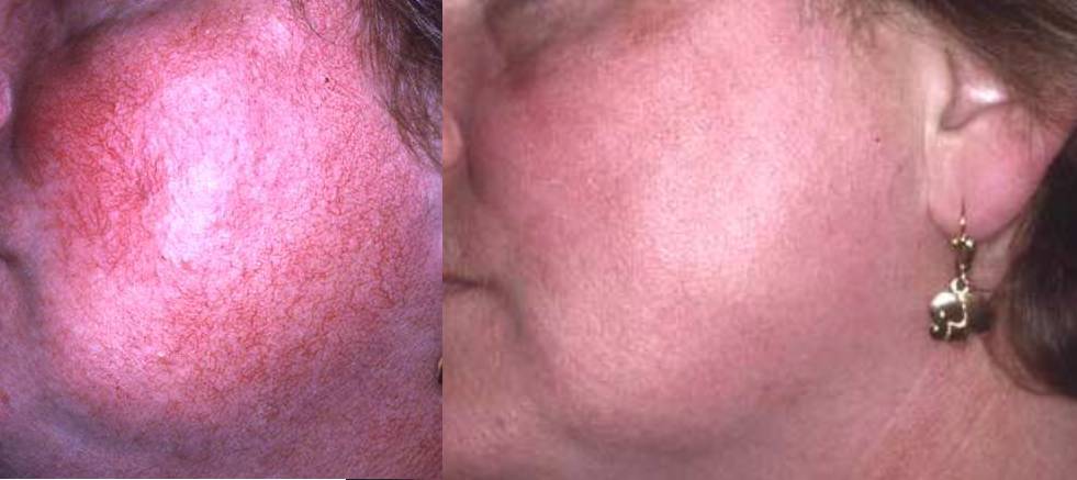 Rosazea und Couperose dermatologisch behandeln