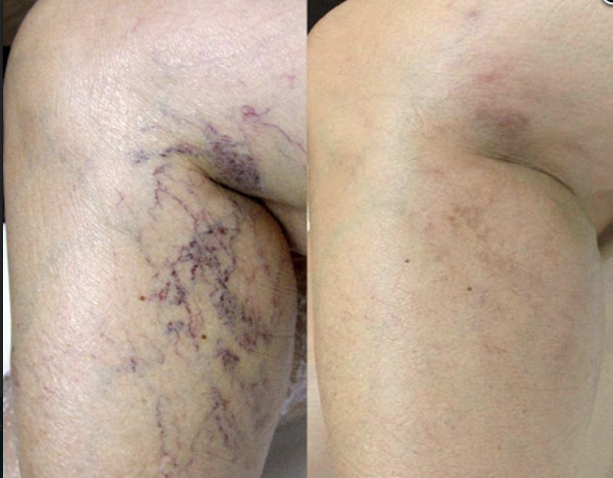 Teleangiektasien und Besenreiser an den Beinen behandeln Teleangiektasien und Besenreiser an den Beinen behandeln