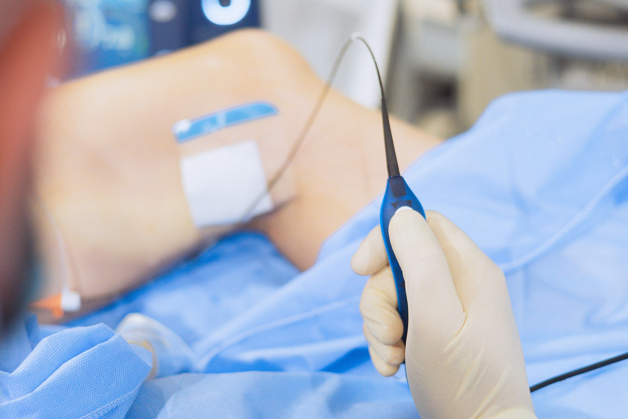 Radiofrequenztherapie und Venenablation bei Venenschwäche