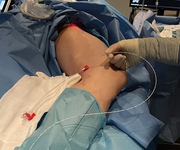 Endovenöse Lasertherapie bei Krampfadern in Hanau