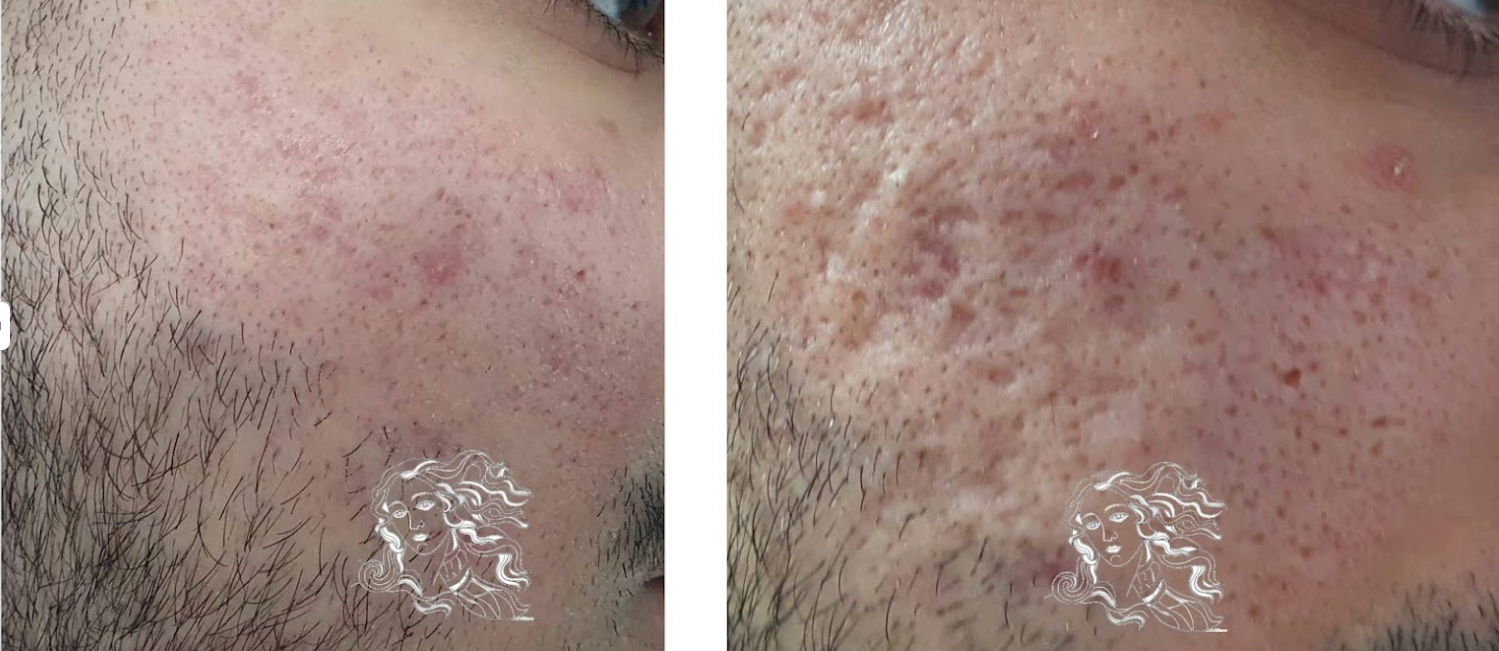 Aknenarben Pico Laser vorher nachher Dermatologie Hanau Aknenarben Pico Laser vorher nachher Dermatologie Hanau