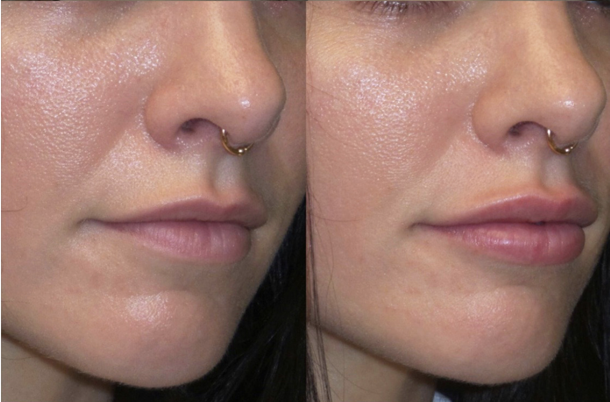 Behandlungsbeispiel Um Vorher Nachher Dermatologie Hanau