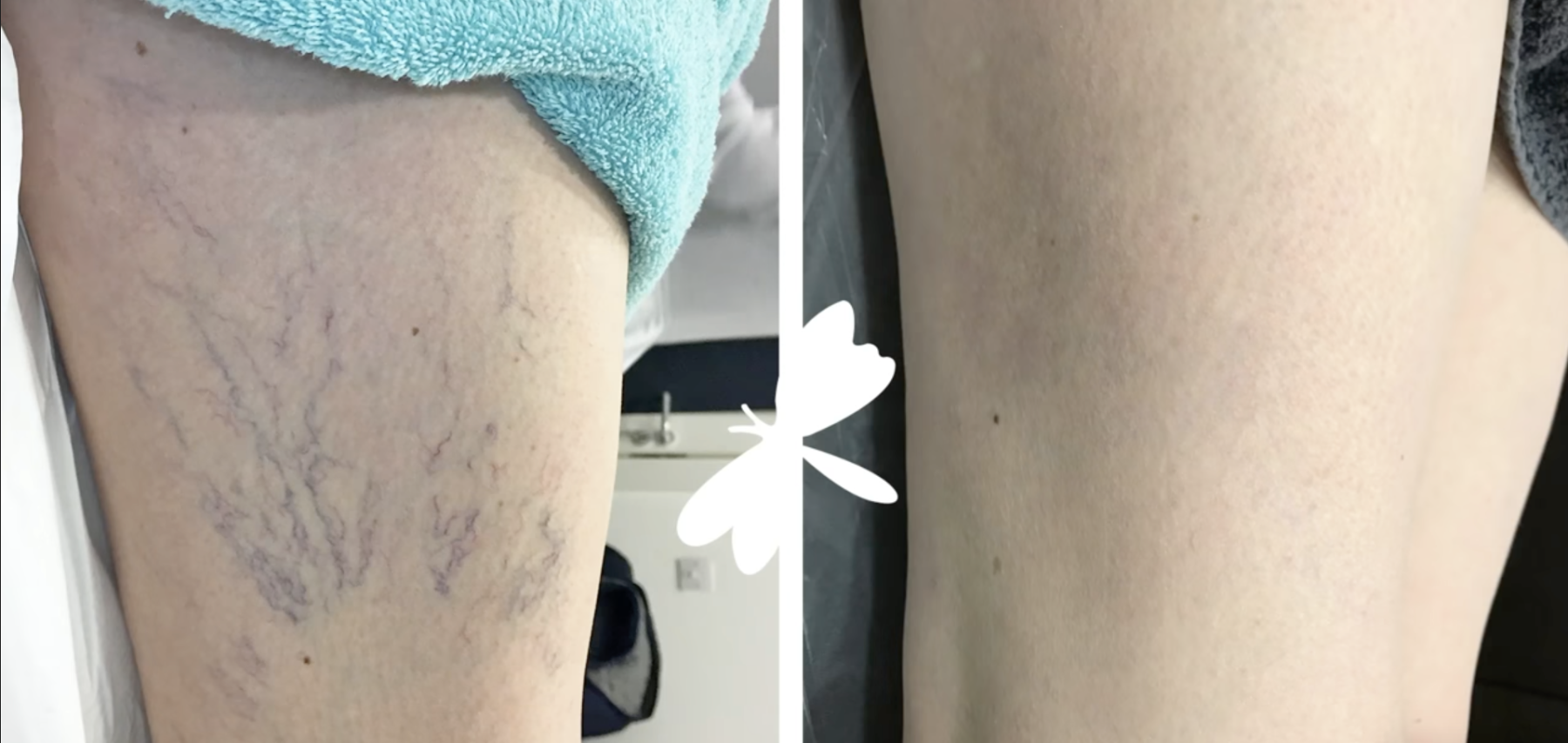 Behandlungsbeispiel Um Vorher Nachher Dermatologie Hanau
