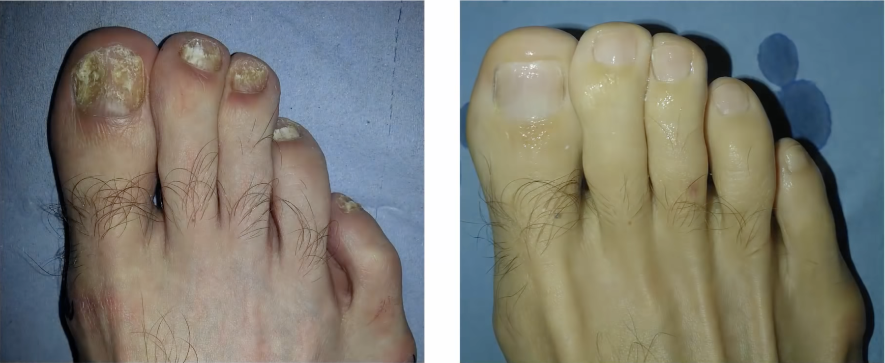Nagelpilz Verlauf Nagelpilz Verlauf