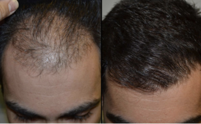 Haartherapie Verlauf 1