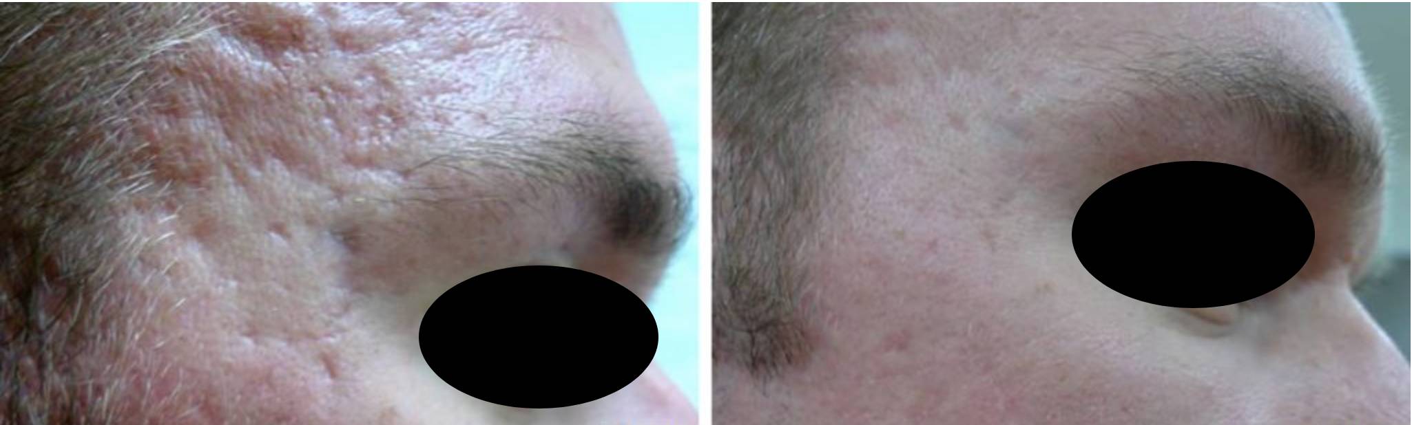 CO2 Laser AkneNarben Vorher Nachher Dermatologie Hanau