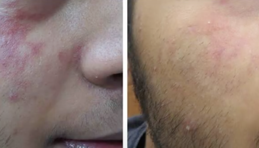 Feuermal Vorher Nachher Vorher Nachher Dermatologie Hanau