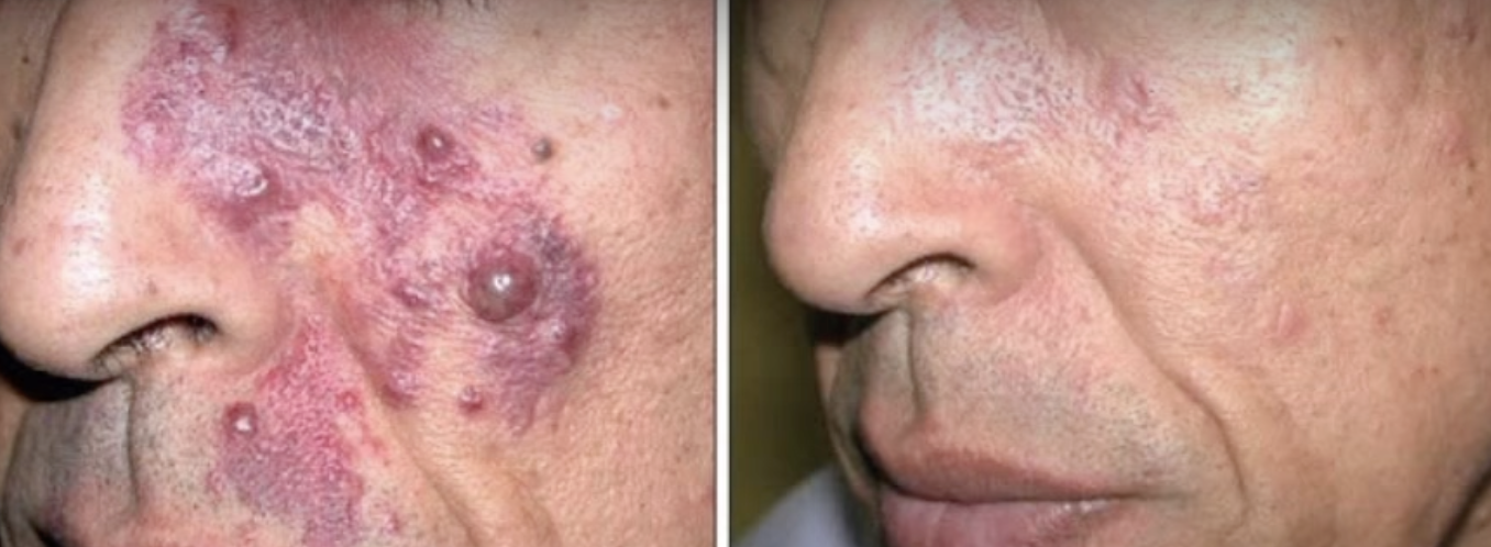 Feuermal Vorher Nachher1 Vorher Nachher Dermatologie Hanau