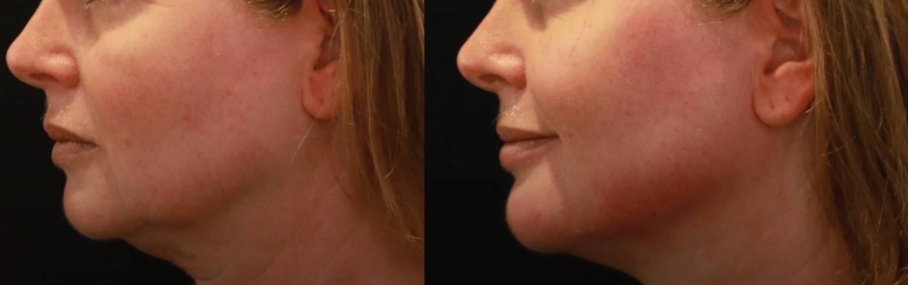 Haengebaeckchen Vorher Nachher Dermatologie Hanau