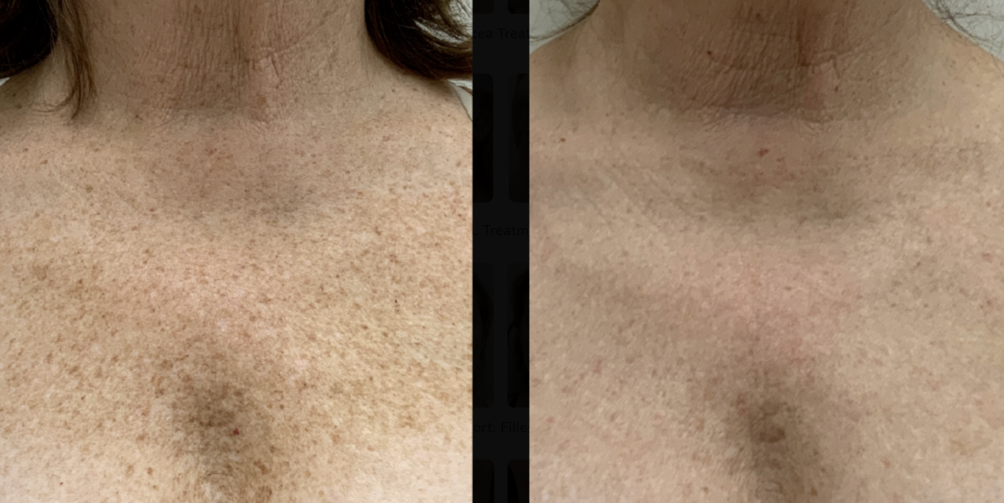 Hautbild Verbesserung Vorher Nachher Dermatologie Hanau