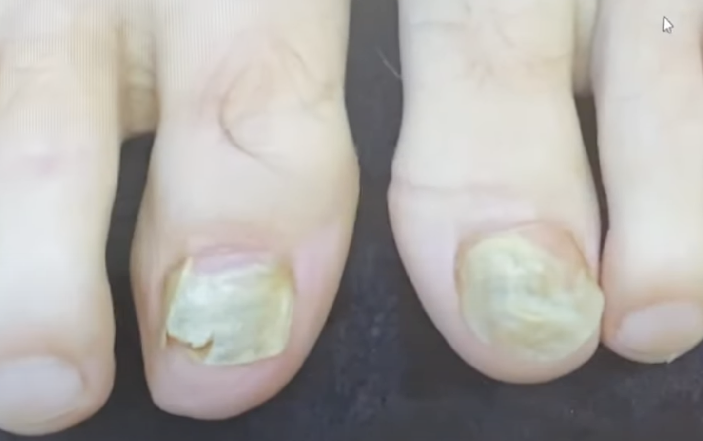 Nagelpilz Mit Laser Vorher Nachher Dermatologie Hanau