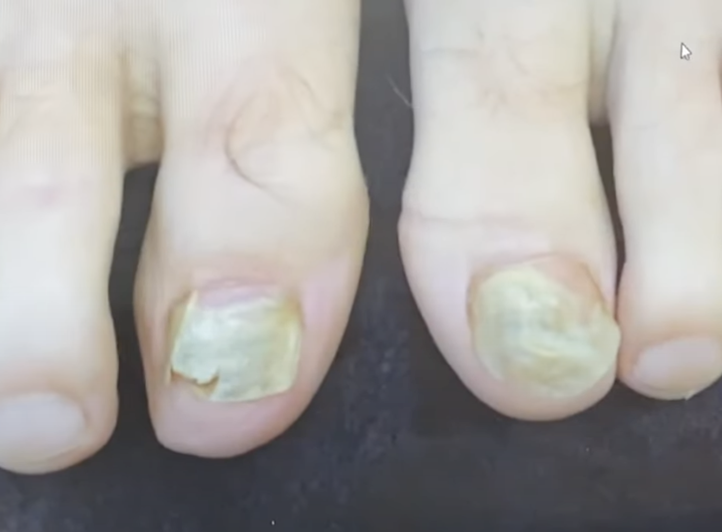 Nagelpilz Laser Verlauf Nagelpilz Laser Verlauf