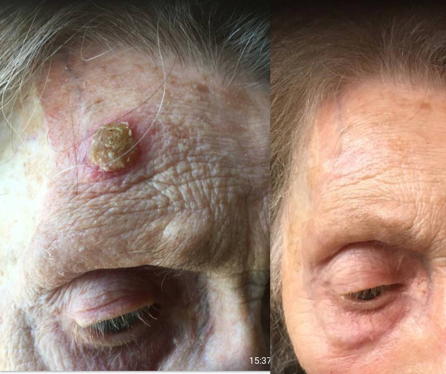 Neues Projekt Vorher Nachher Dermatologie Hanau