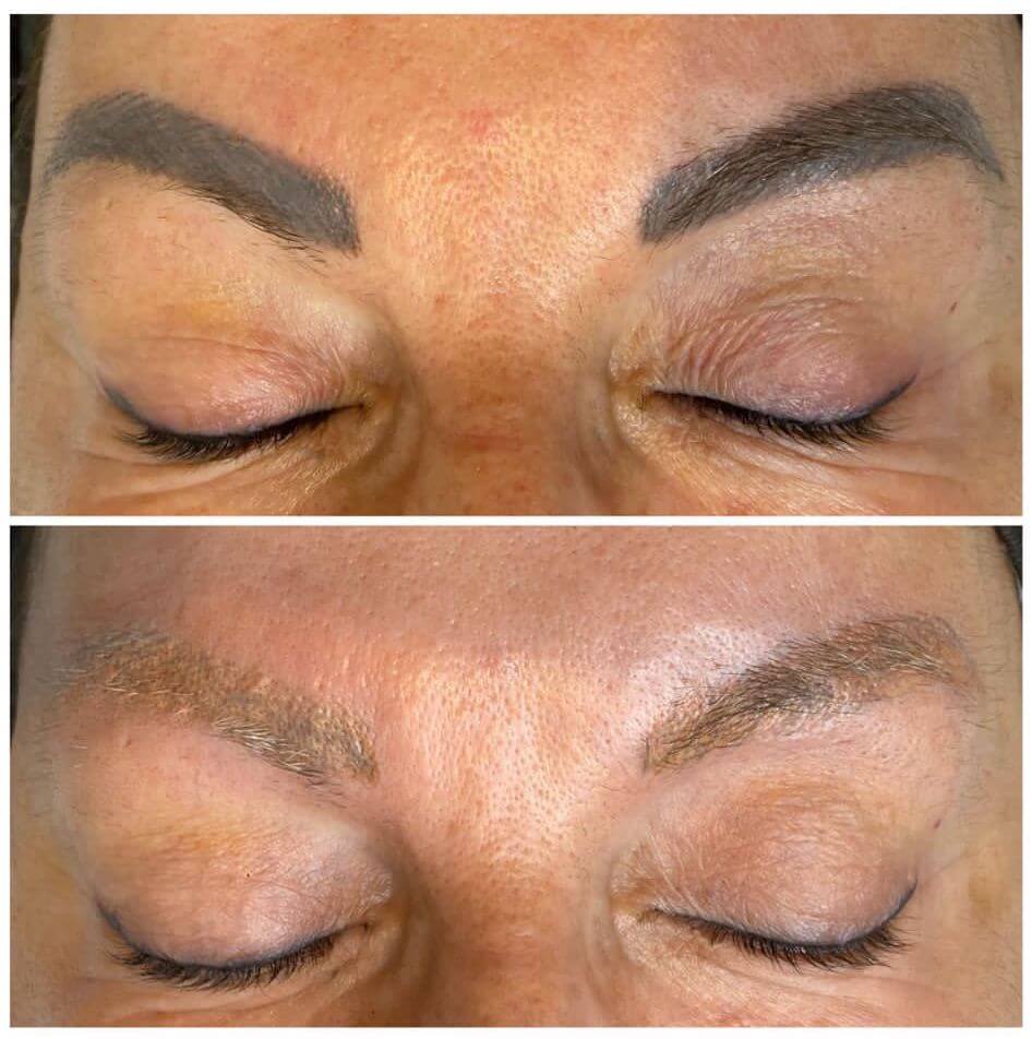 Microblading Entfernung 2