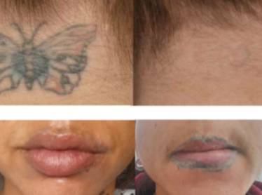 Permanent Make Up Entfernung Vorher Nachher Dermatologie Hanau