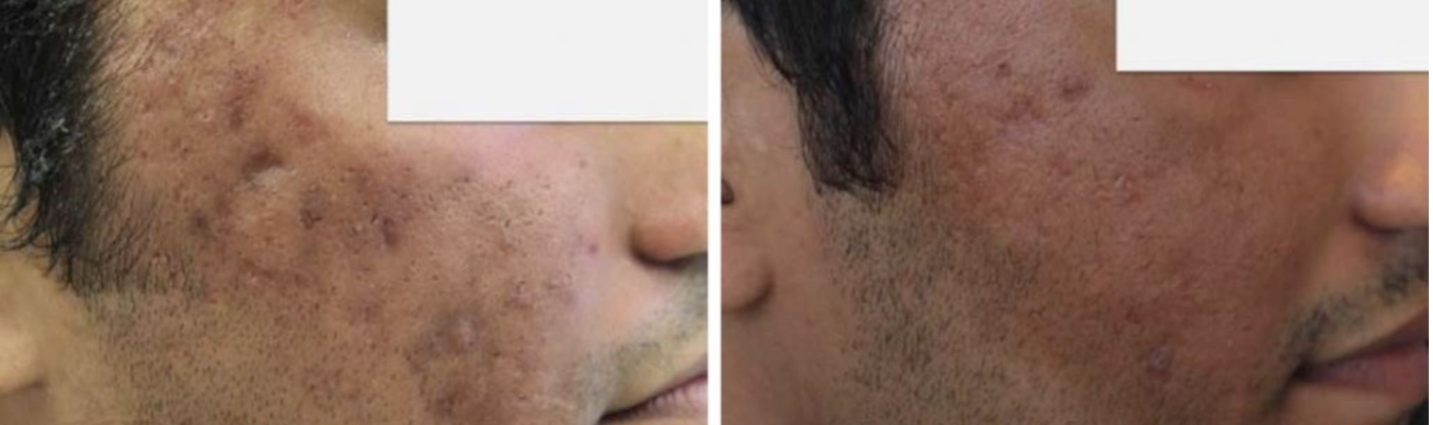 Aknenarben Laser CO2 vorher nachher Beispiel Aknenarben Laser CO2 vorher nachher Beispiel