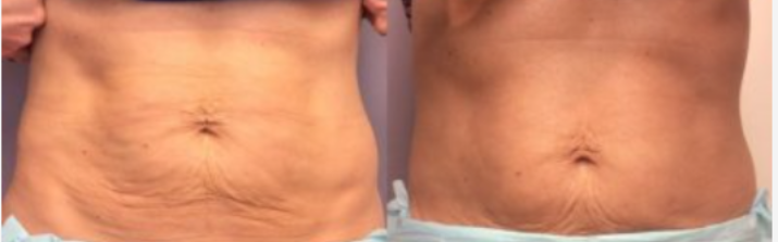 Bauchdeckenstraffung Vorher Nachher Dermatologie Hanau