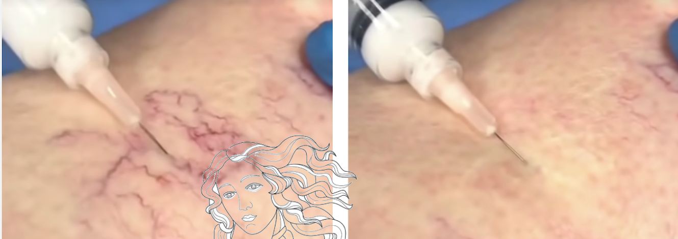 Besenreiser Behandlung Vorher Nachher Dermatologie Hanau