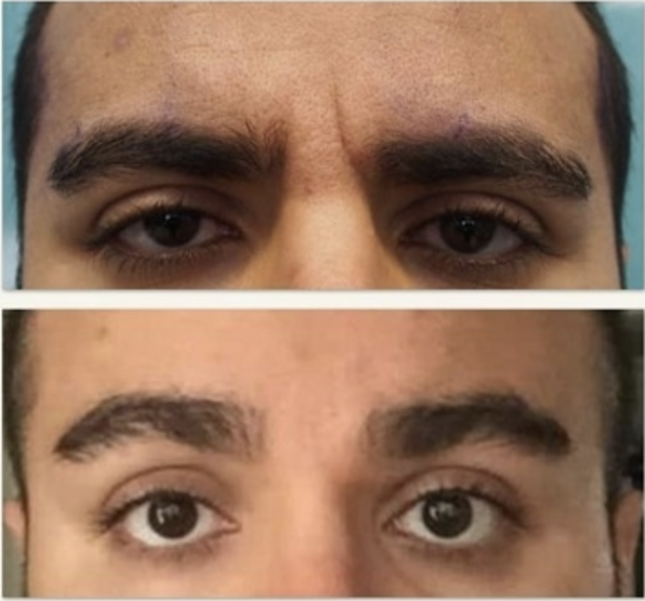 Botox Zornfalten Vorher Nachher Dermatologie Hanau