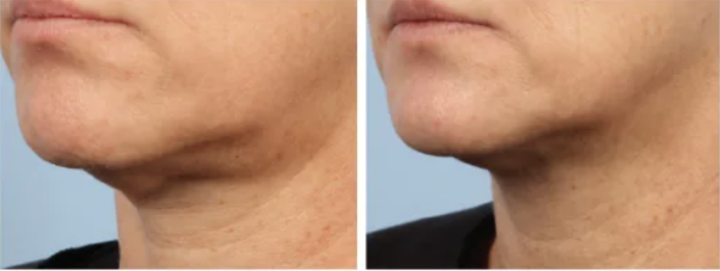 Candela Matrix Avant Apres Vorher Nachher Dermatologie Hanau
