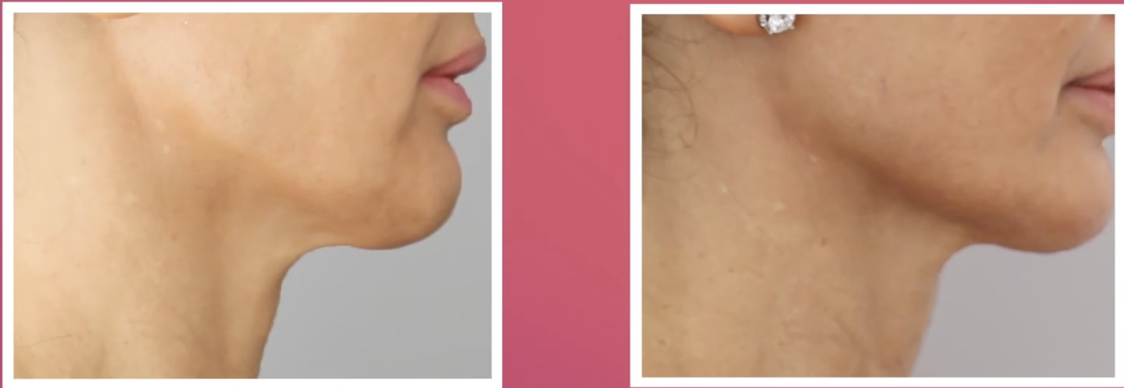 Candela Matrix Vorher Nachher Vorher Nachher Dermatologie Hanau