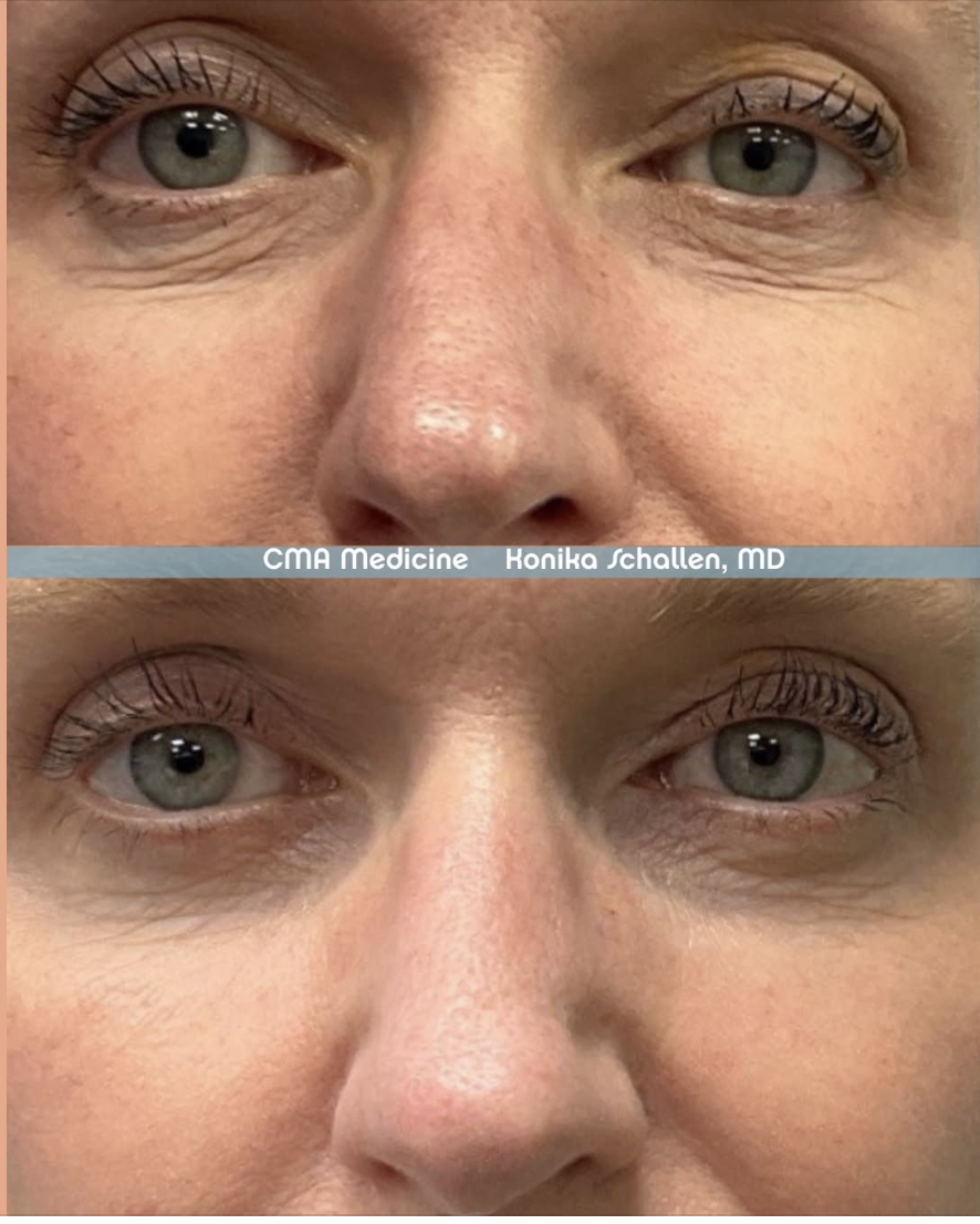 Candla Matrix Avant Apres Vorher Nachher Dermatologie Hanau